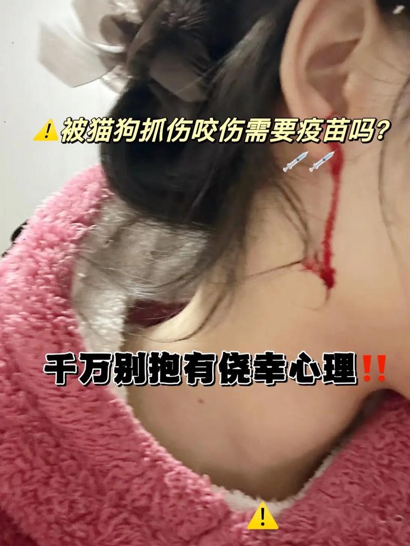 被宠物猫咬伤腿溃烂;被猫咬破腿腿怎么办