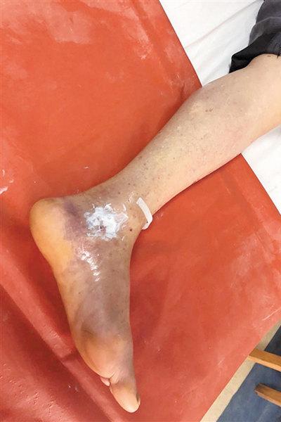 新奥今晚特马上9点30和被蛇咬反抓蛇再遭咬与被蛇咬反抓蛇再遭咬伤